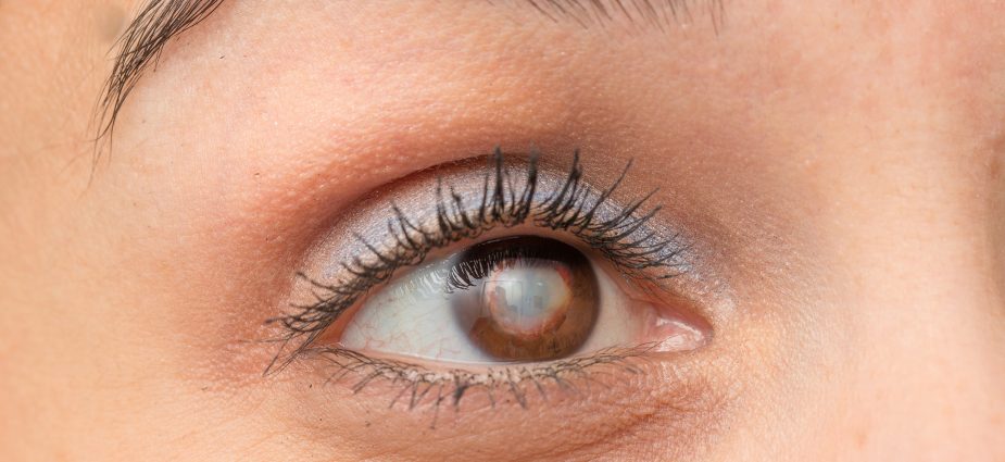 close up of female brown eye with a cataract