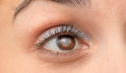 close up of a female cataract patient's right eye