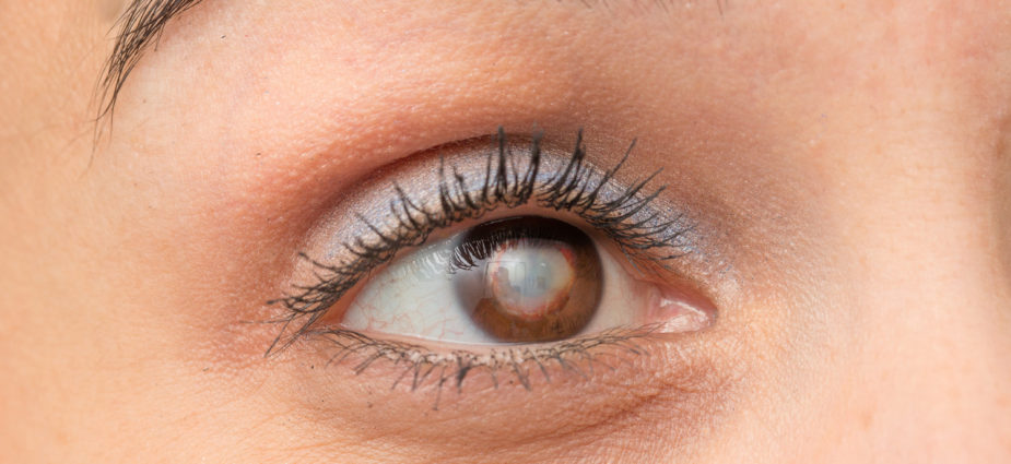 close up of a brown female eye with a cataract