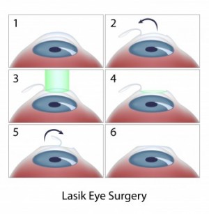 step-by-step illustration of LASIK eye surgery in 6 stages