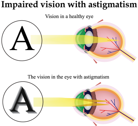 astigmatism types facts three nearsighted myopic vision corneal