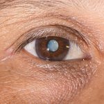 close up of a man's eye with a cataract