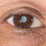 close up of a male brown eye with a cataract