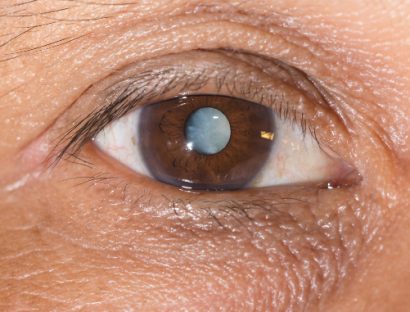 close up of a man's eye with a cataract