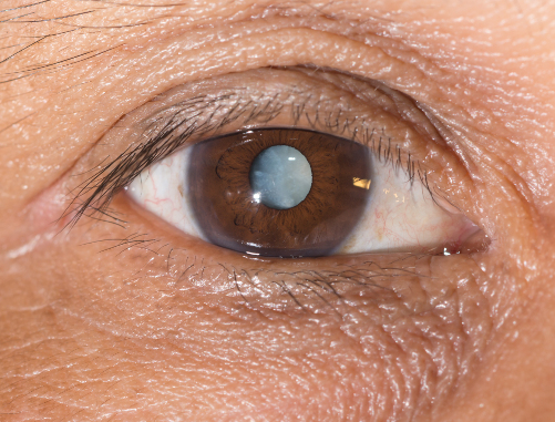 close up of a male brown eye with a cataract