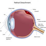 detailed medical illustration showing retinal detachment