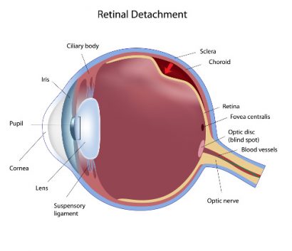 detailed medical illustration showing retinal detachment