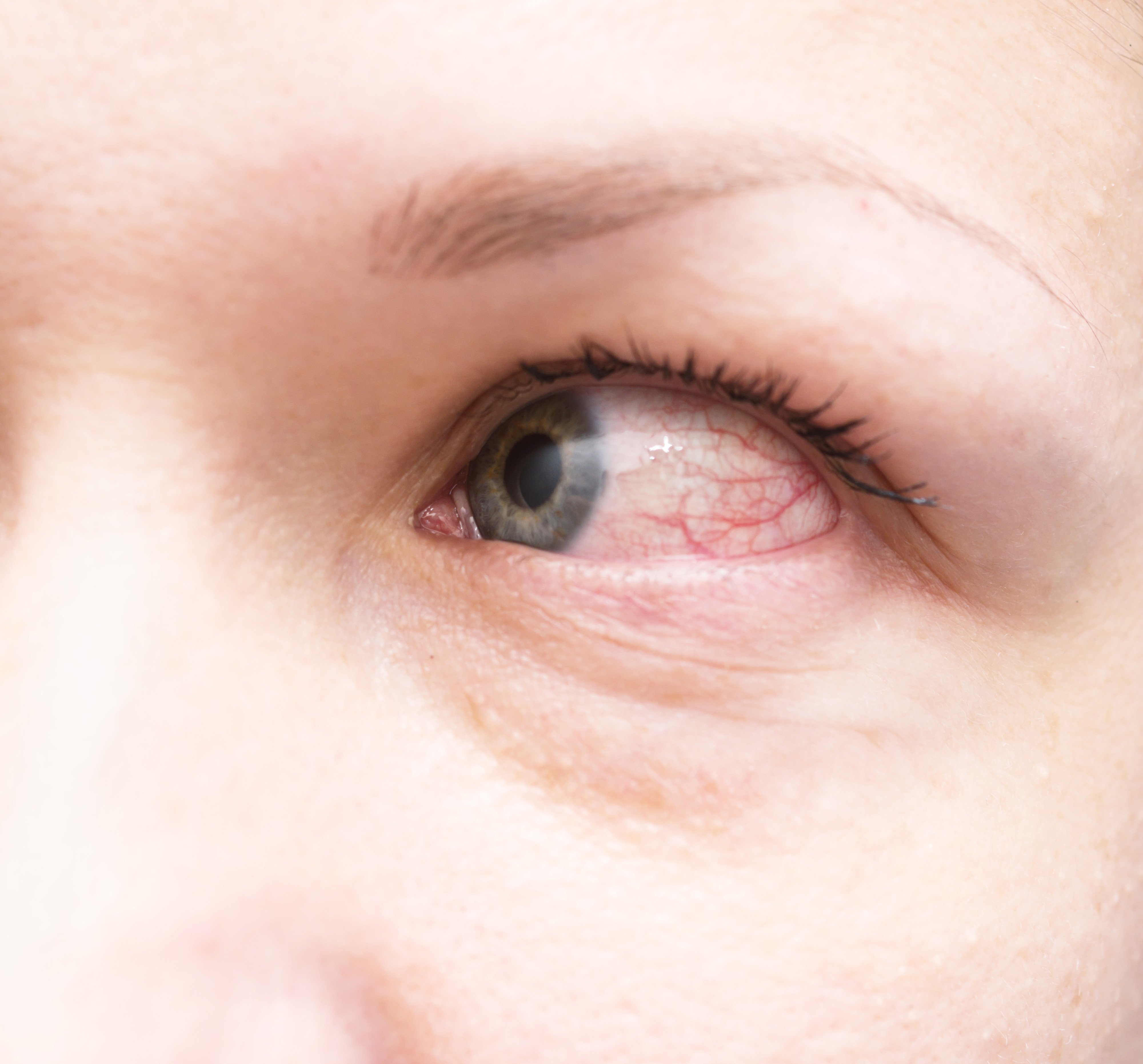 9 Causes of Red Eyes