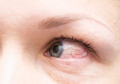 <strong>Common Triggers of Red Eyes</strong>