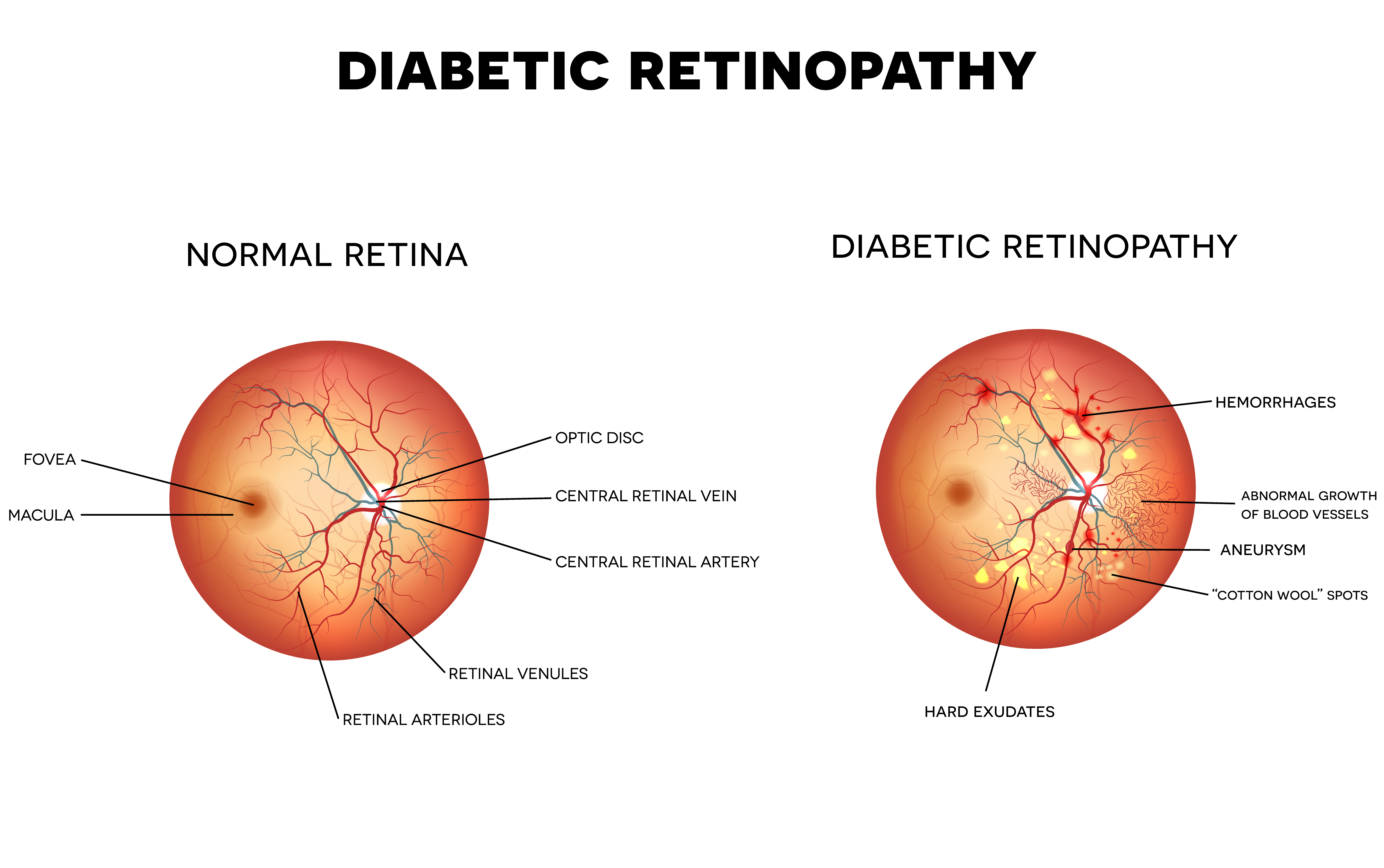 Diabetic retinopathy retinal laser surgery