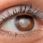 close up image of a female's brown eye with a cataract