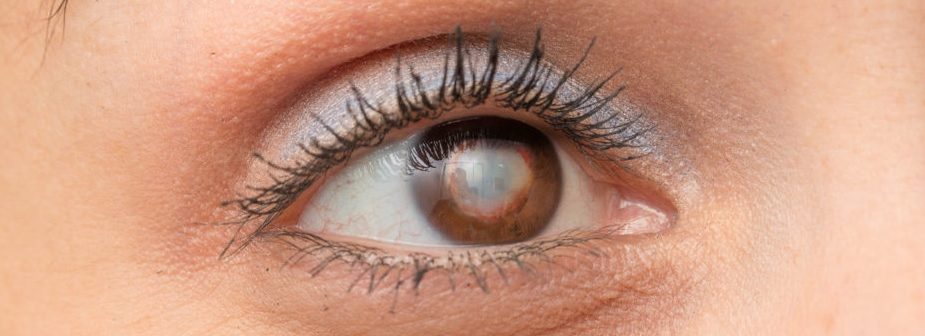 close up image of a female's brown eye with a cataract